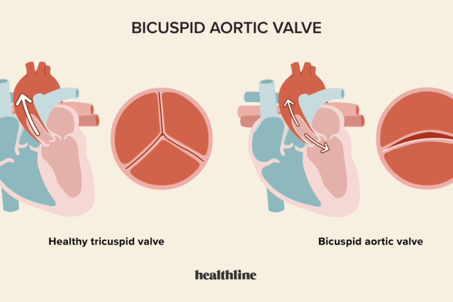 Bicuspid Aortic Valve: Diagnosis, Treatment, And Outlook
